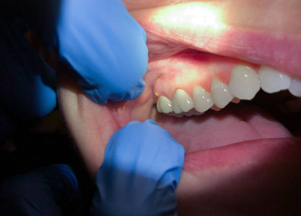 Best Chipped Tooth Repair Near Me  in Pennside, PA